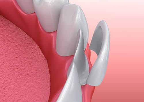 bethpage dental veneers