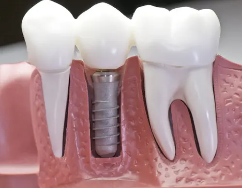 single dental implant