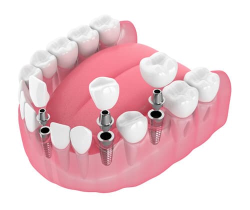 same-day dental implants