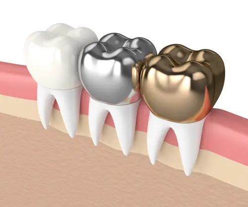 different types of dental crowns