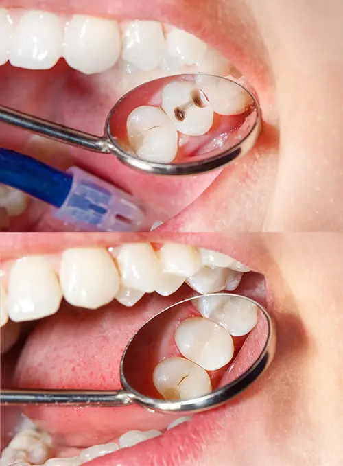 Dental Fillings