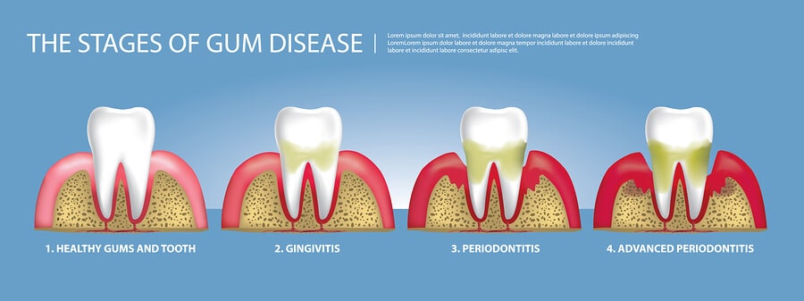 the stages of gum disease