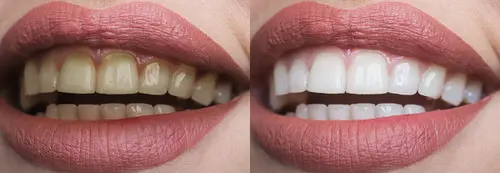 before and after teeth whitening