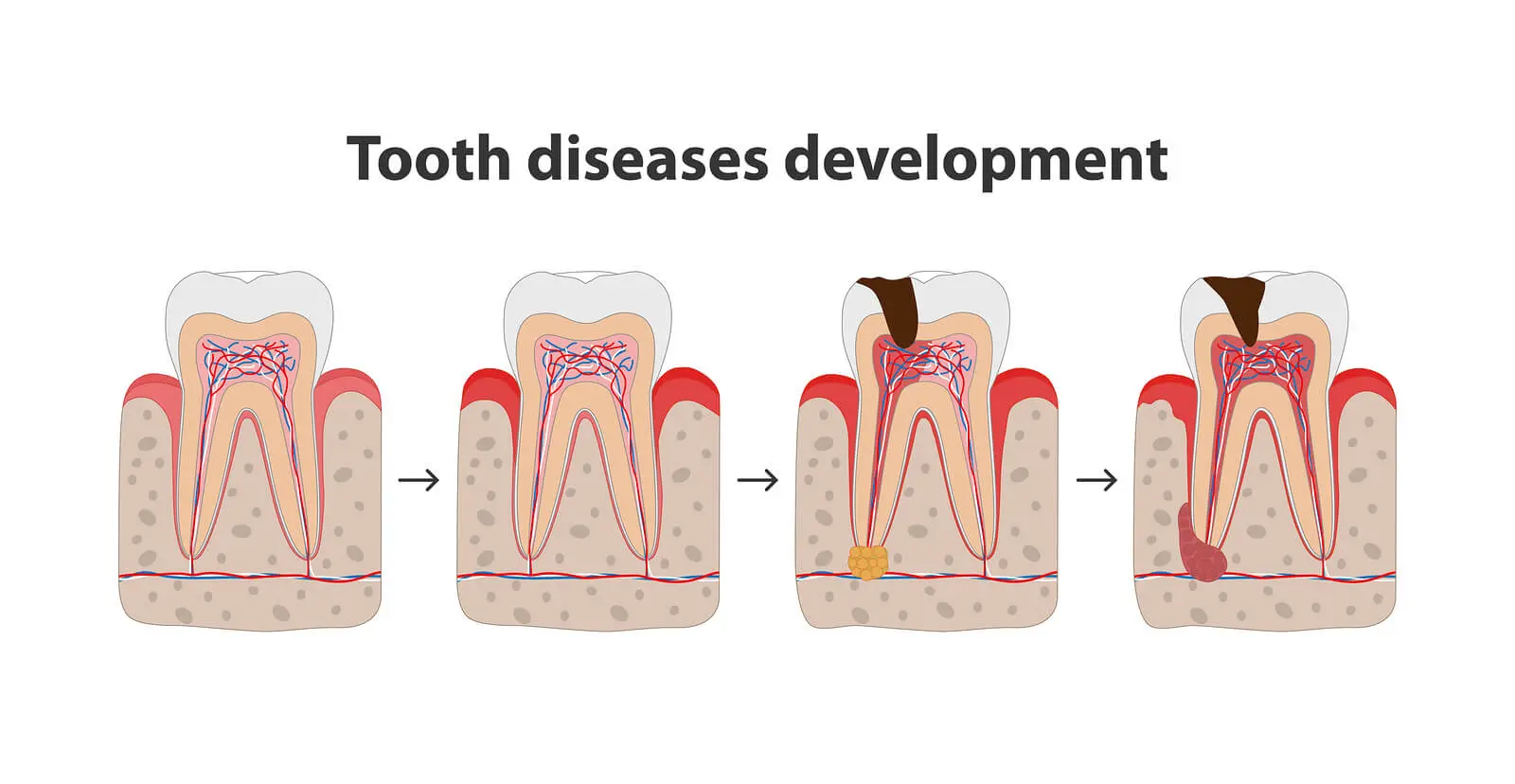 tooth diseases development