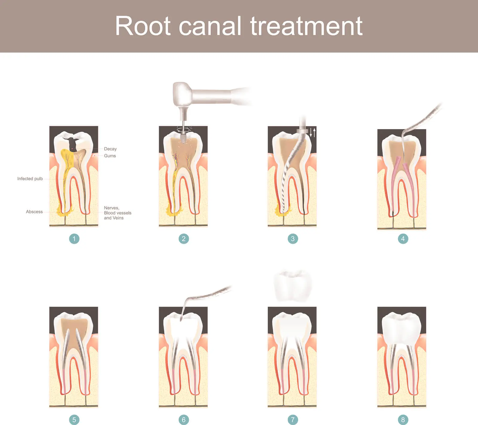 root canal treatment