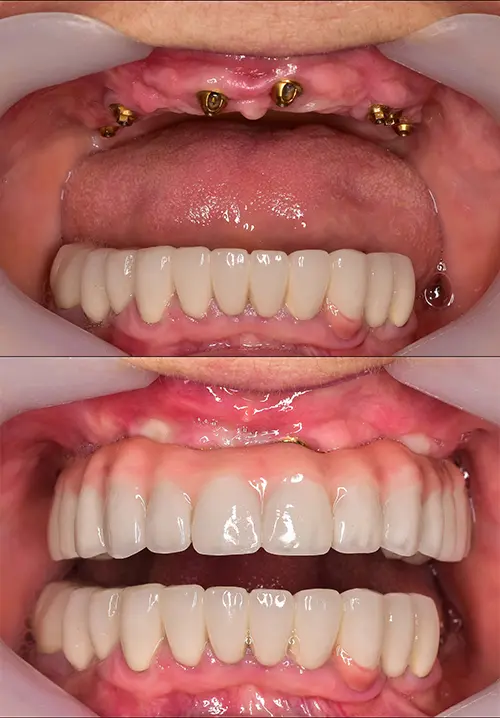 traditional dental implants