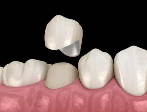 bethpage dental crown