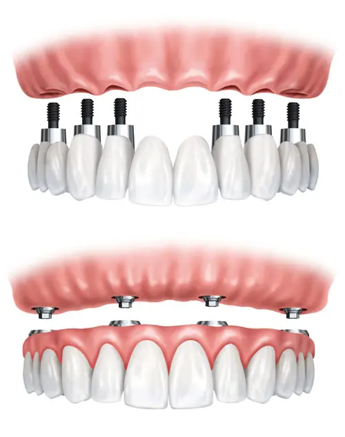 full arch dental implants