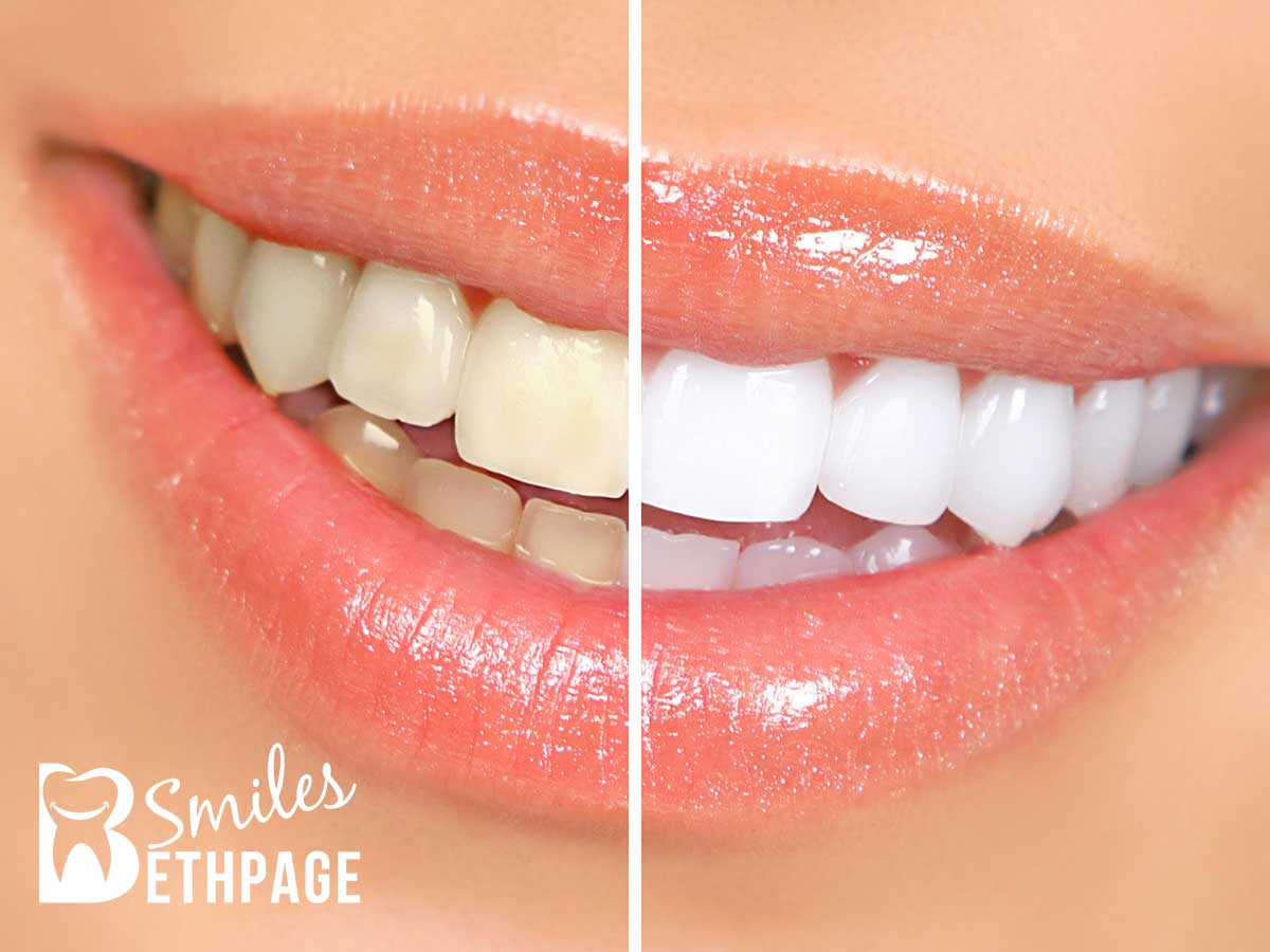 Before & After a Teeth Whitening Procedure In Bethpage, NY
