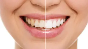 before and after teeth whitening